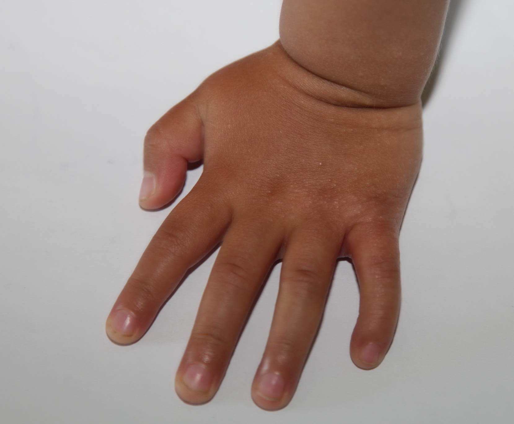 宝宝2岁10个月，双手手背长小疹子，手心长的红斑比较大发硬，热的时候痒 - 百度宝宝知道